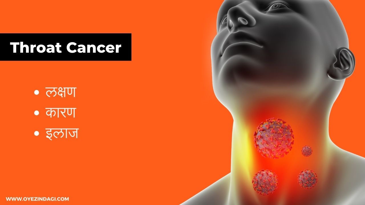 Throat Cancer